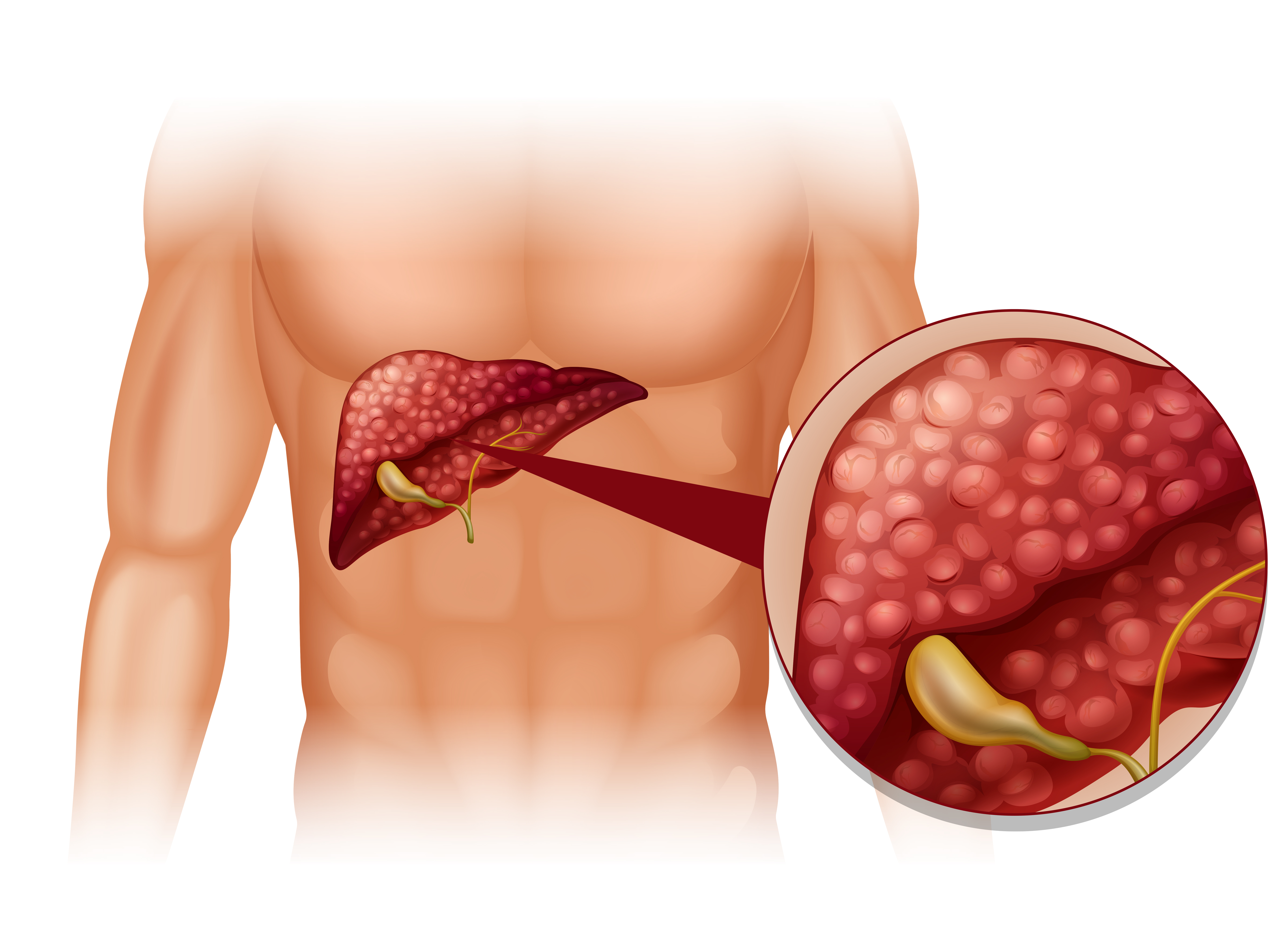  liver tumor